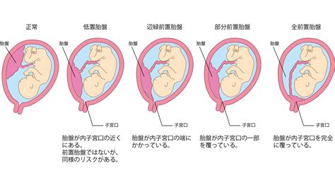 前置胎盤原因|前置胎盤の原因、確率、出産リスク、判明時期 治る？繰り返。